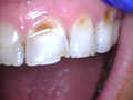 Zoomed in Image of a Set of Teeth with Damage