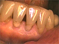 Zoomed in Image of a Set of Teeth with Receding Gums